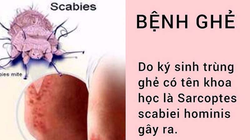 Các biện pháp phòng chống bệnh Ghẻ